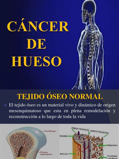 cancer de huesos-4
